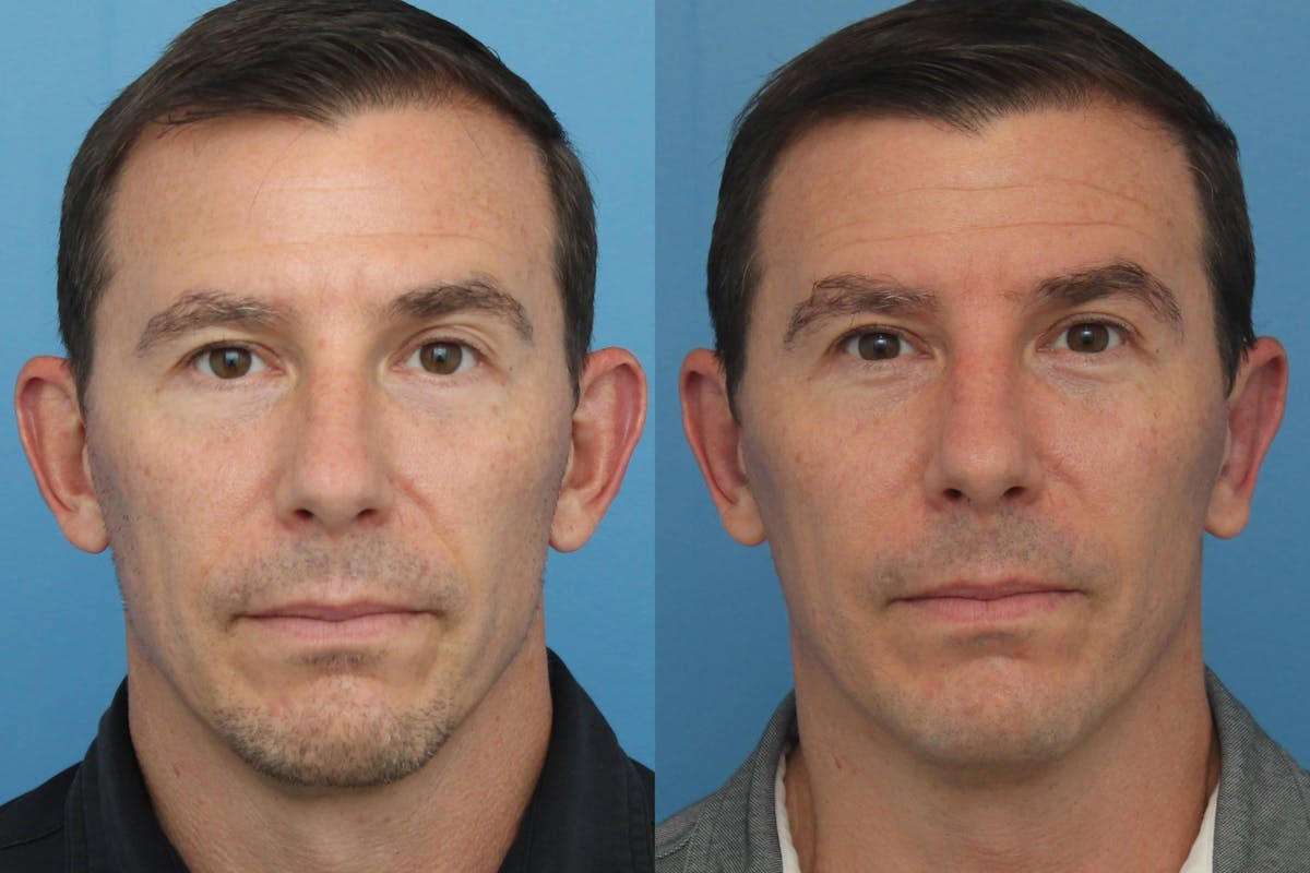 Otoplasty (Ear Surgery) Before & After Gallery - Patient 126269 - Image 1