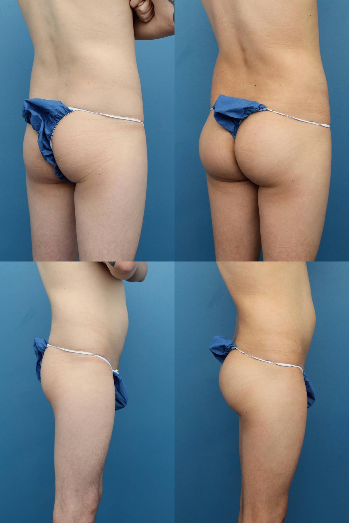 Buttock Augmentation with Implants Before & After Gallery - Patient 741799 - Image 1