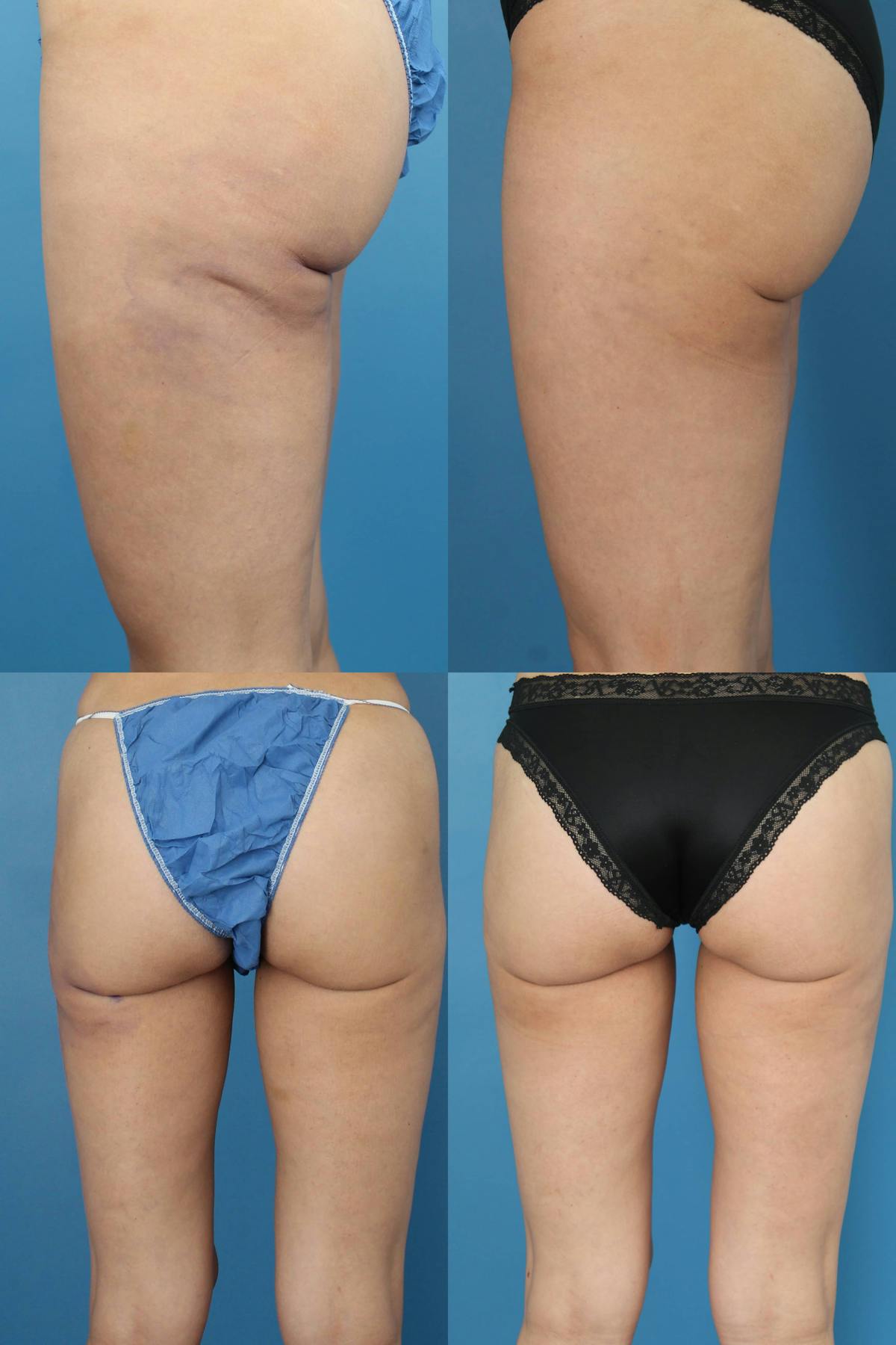 Infragluteal Fat Grafting Before & After Gallery - Patient 163532 - Image 1