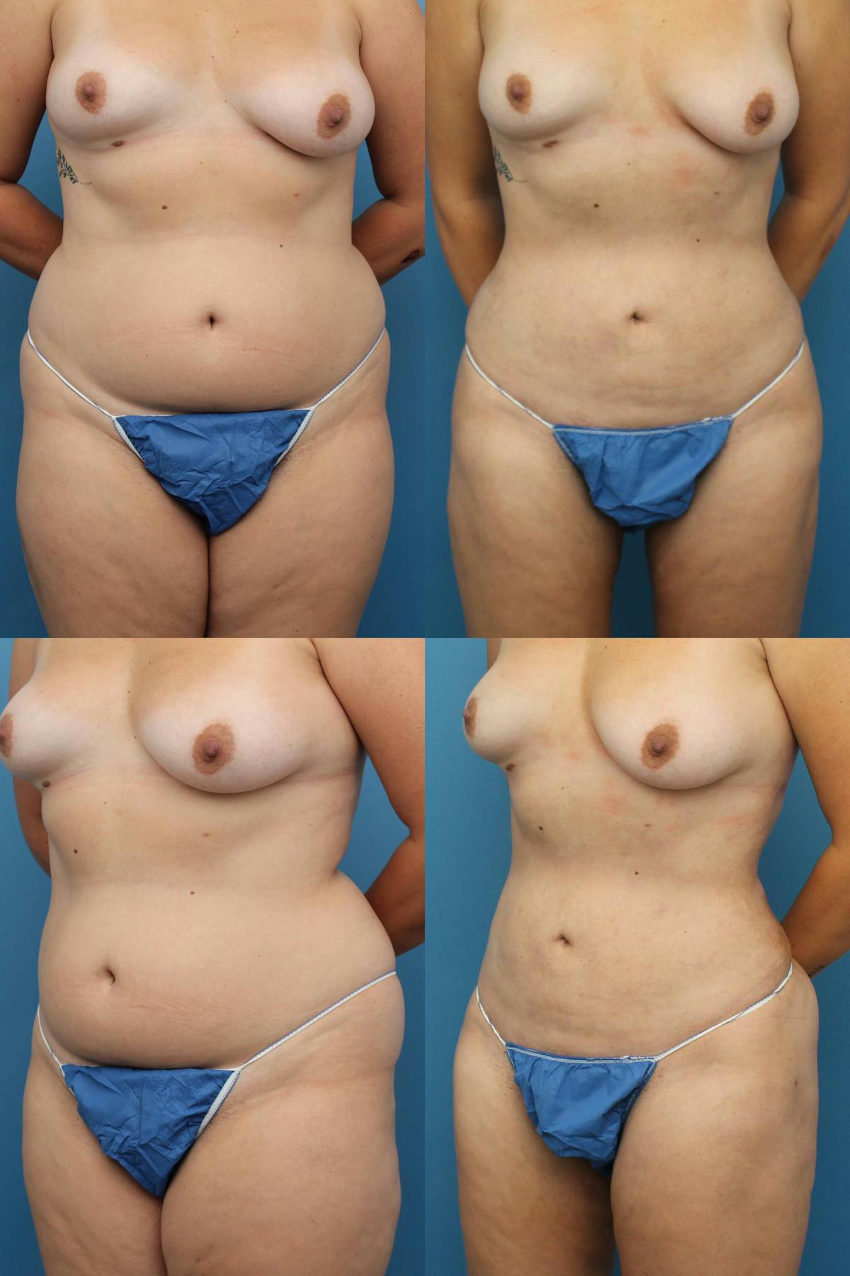 Liposuction Before & After Gallery - Patient 186179 - Image 1