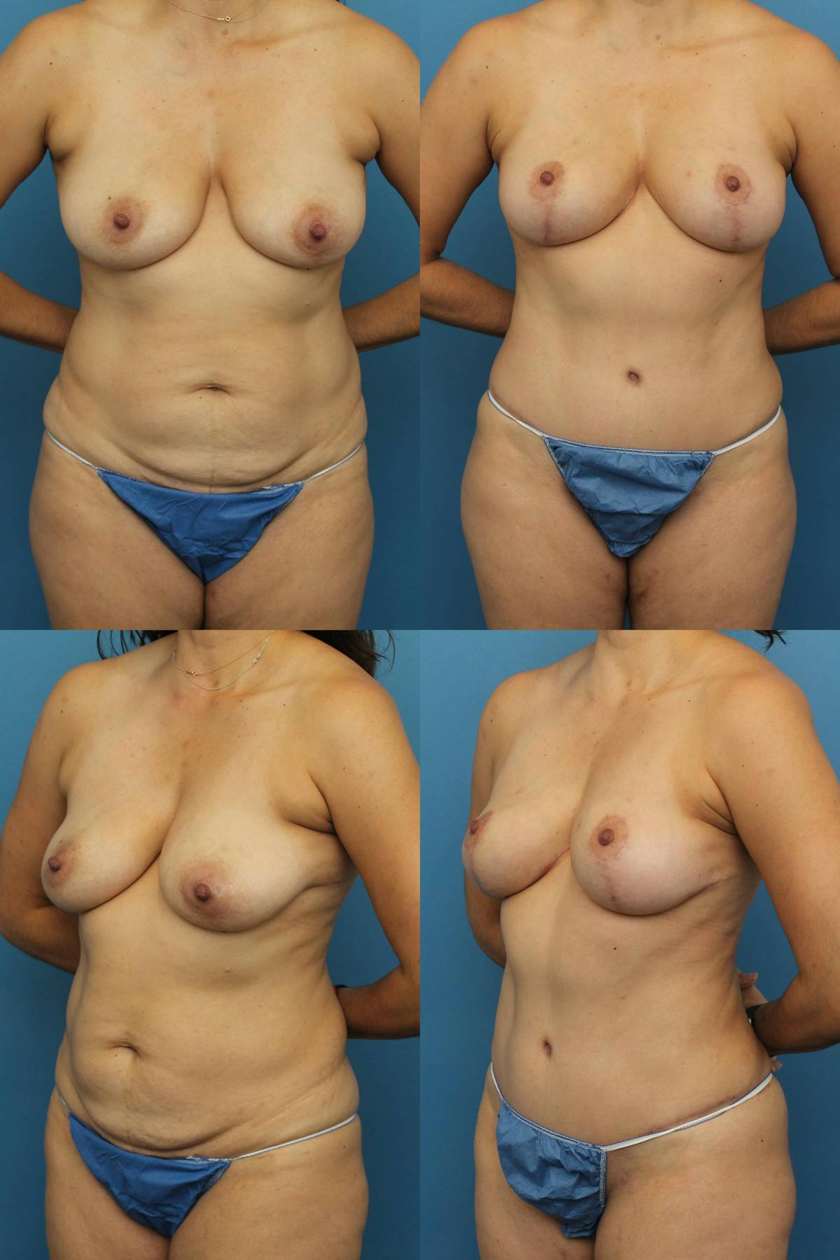 Tummy Tuck Before & After Gallery - Patient 229503 - Image 1
