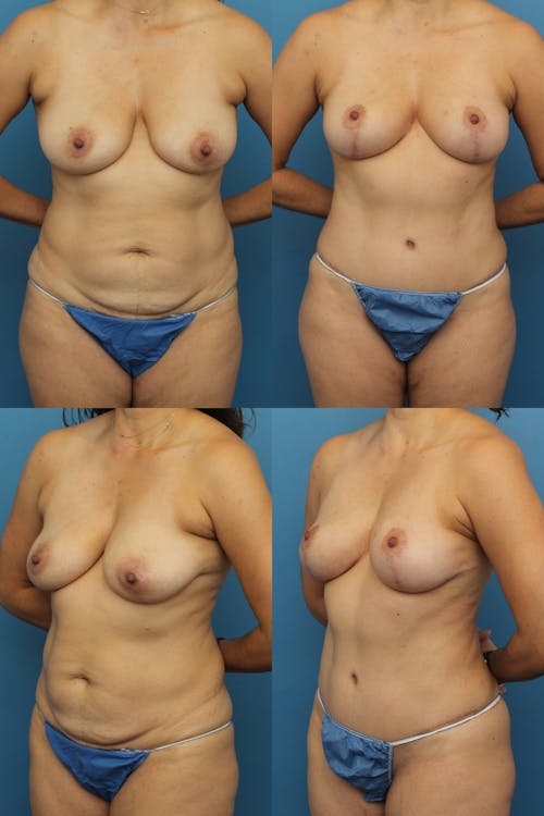 Patient 3 Before - Tummy Tuck