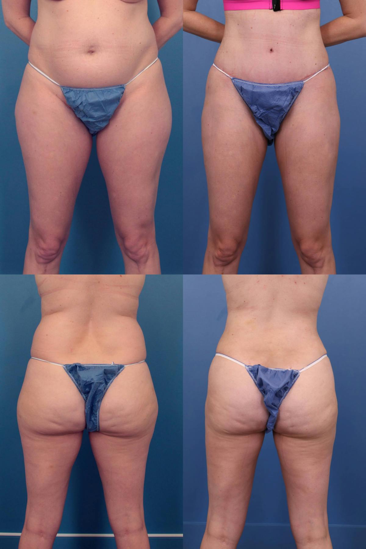 Thigh Liposuction Before & After Gallery - Patient 113474 - Image 1