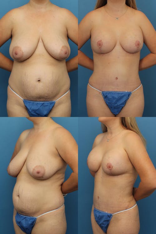 Patient 1 Before - Tummy Tuck
