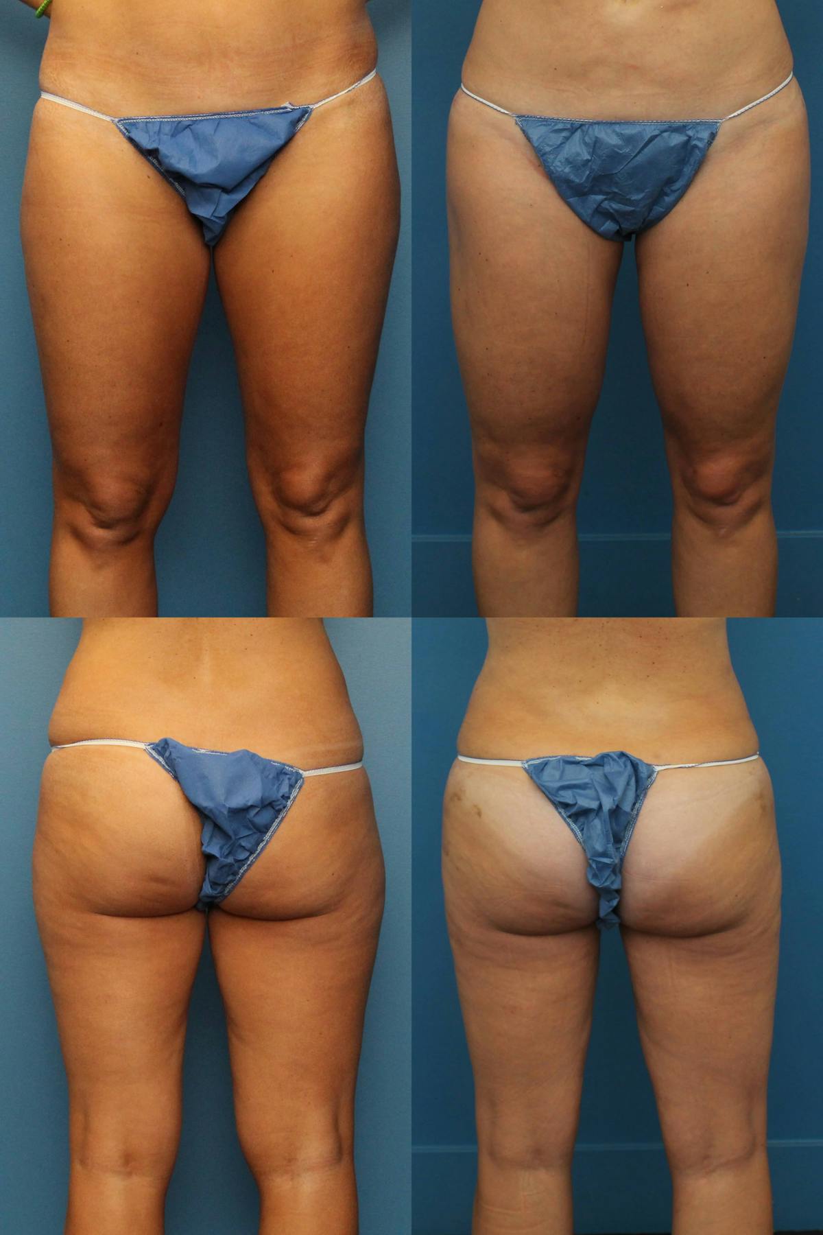 Thigh Liposuction Before & After Gallery - Patient 167460 - Image 1