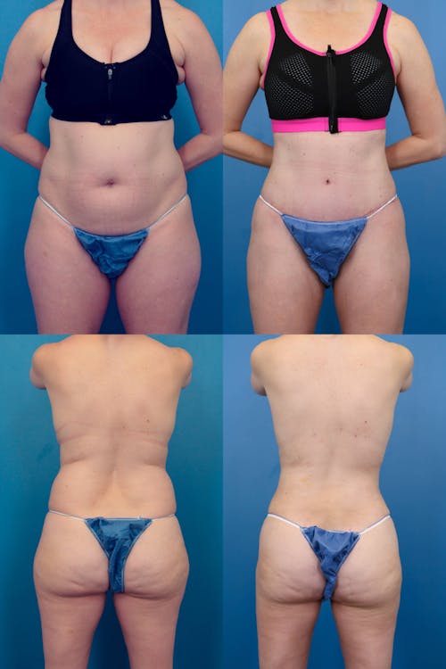 Patient 2 Before - Tummy Tuck