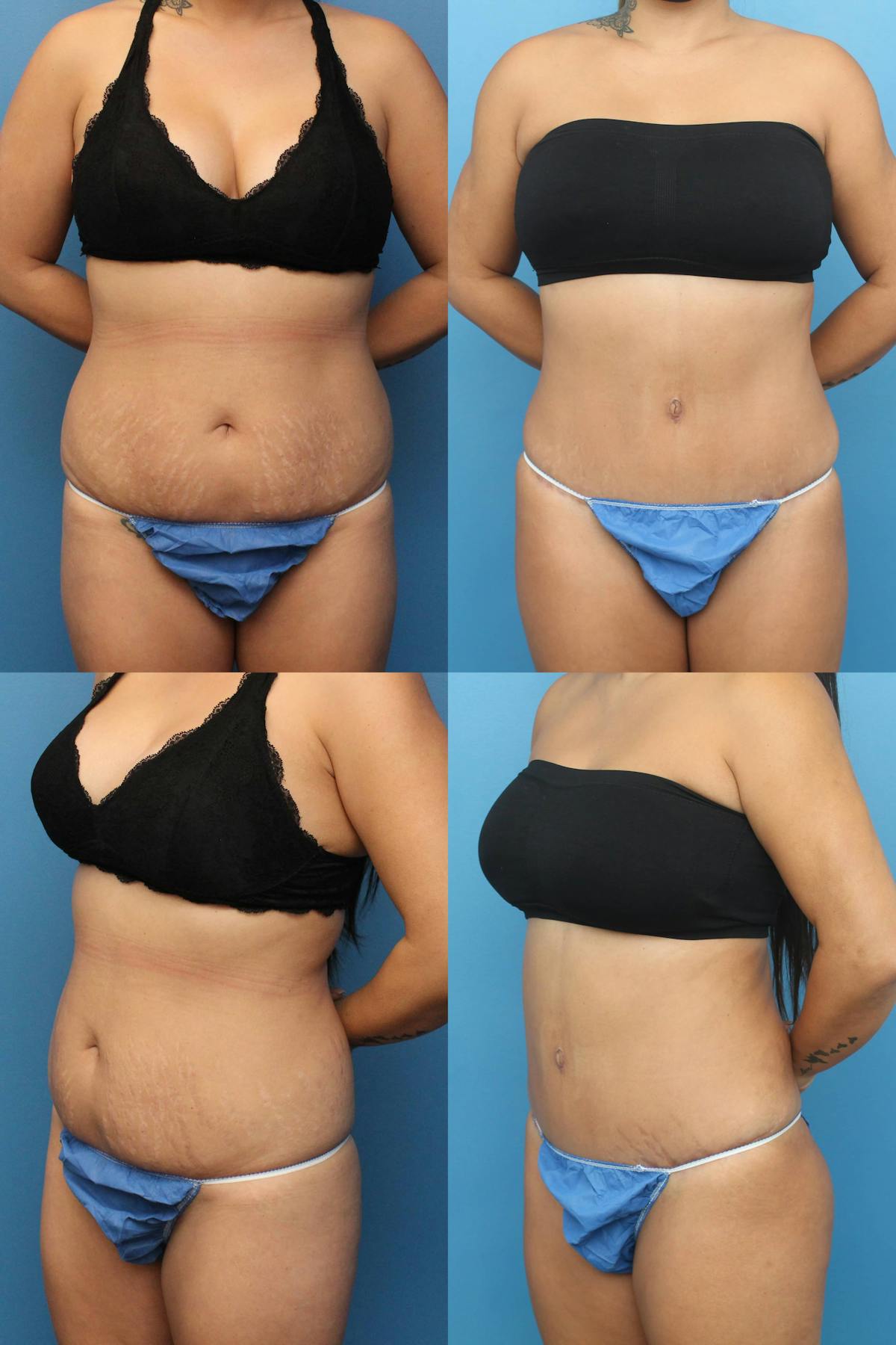 Tummy Tuck Before & After Gallery - Patient 326381 - Image 1