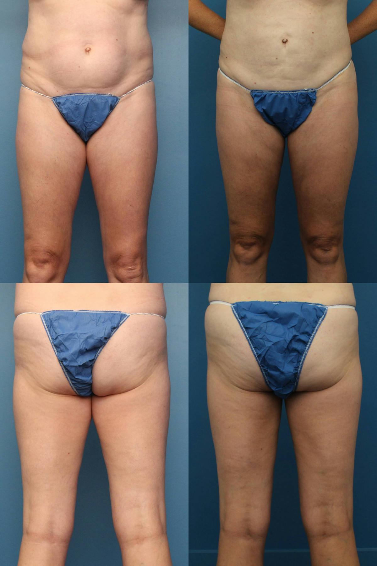 Thigh Liposuction Before & After Gallery - Patient 101157 - Image 1