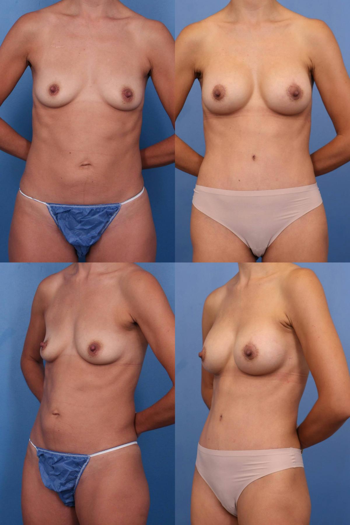 Mommy Makeover Before & After Gallery - Patient 364314 - Image 1