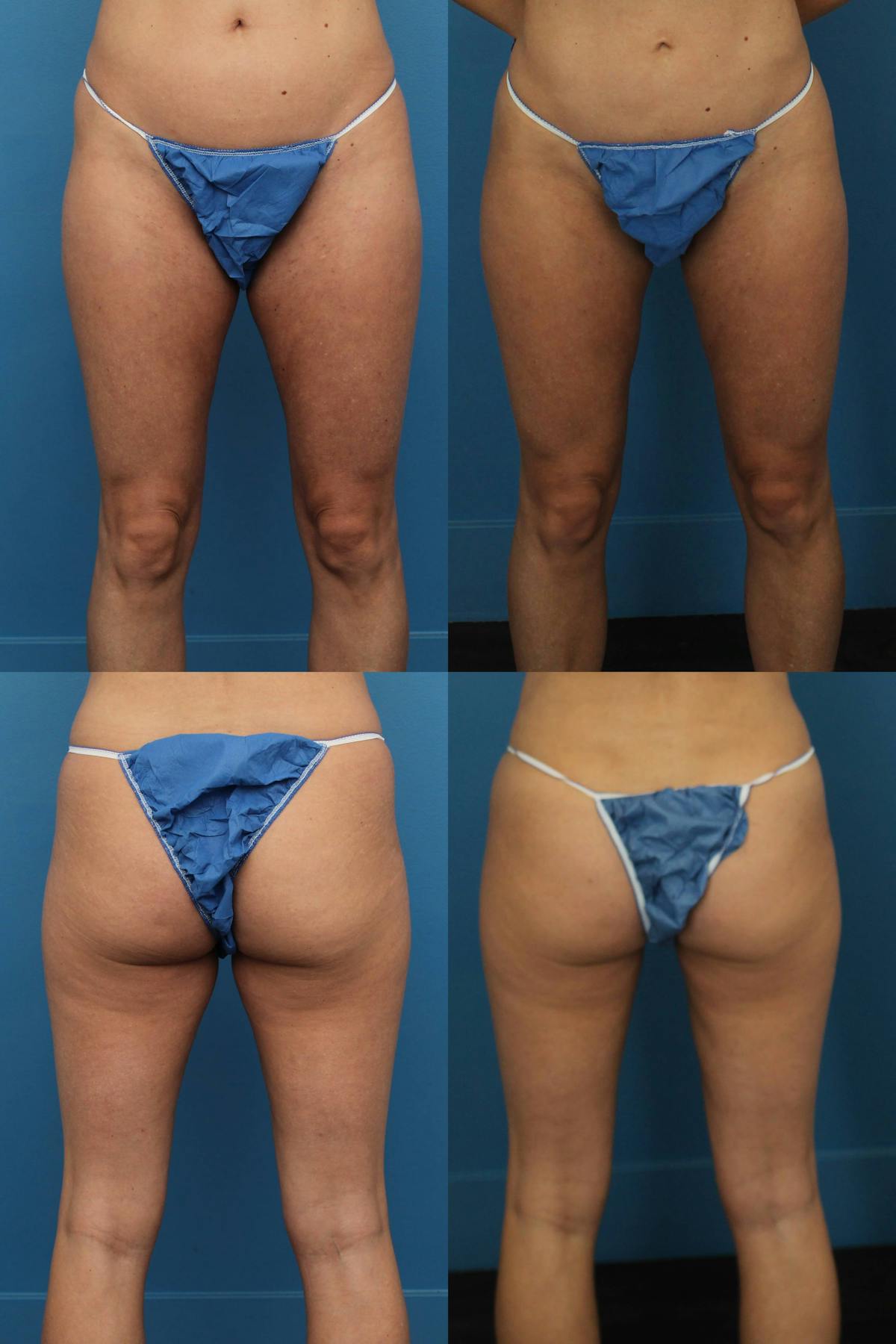 Thigh Liposuction Before & After Gallery - Patient 775488 - Image 1