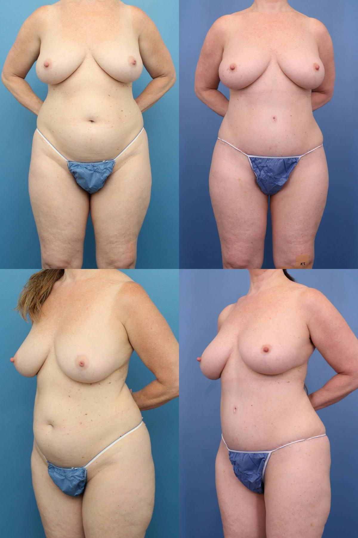 Tummy Tuck Before & After Gallery - Patient 266175 - Image 1