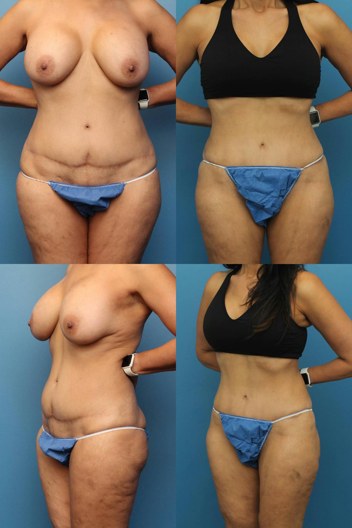 Tummy Tuck Before & After Gallery - Patient 269203 - Image 1