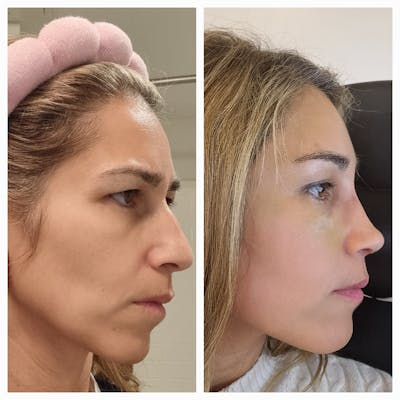 Real Life Patients Before & After Gallery - Patient NNizrJdPT7eKTcOvS2I6aQ - Image 1