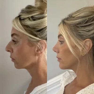 Real Life Patients Before & After Gallery - Patient G0_j44l3T-KtcHu0xjsgBg - Image 1