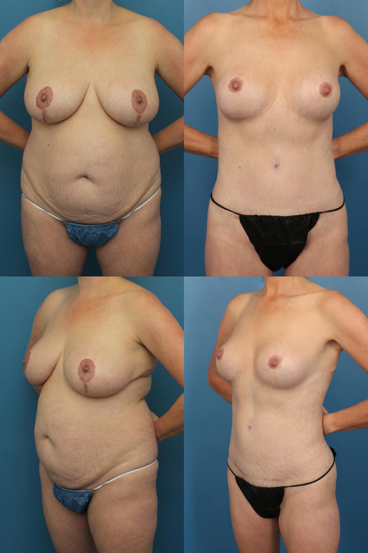 Tummy Tuck Before & After Gallery - Patient 642042 - Image 2