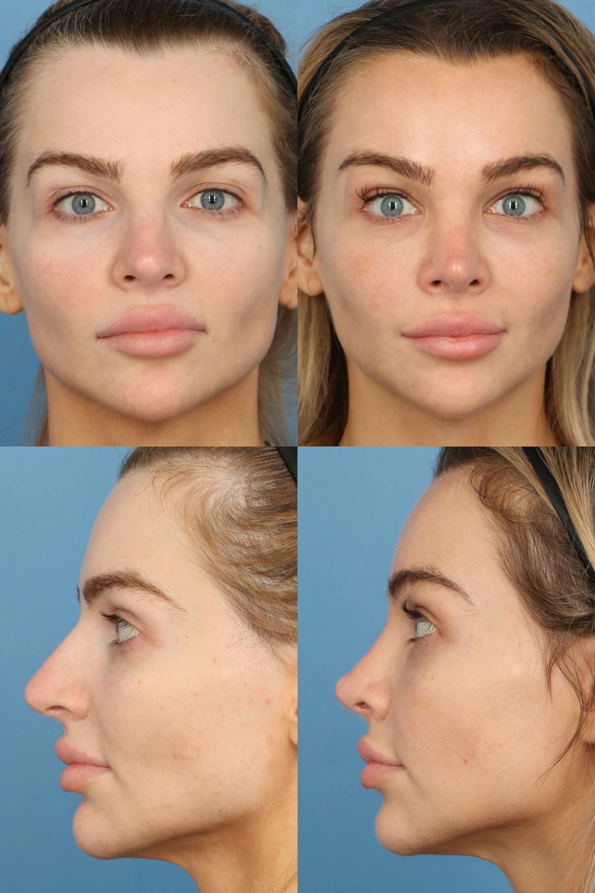 Female Revision Rhinoplasty Before & After Gallery - Patient 102679 - Image 1