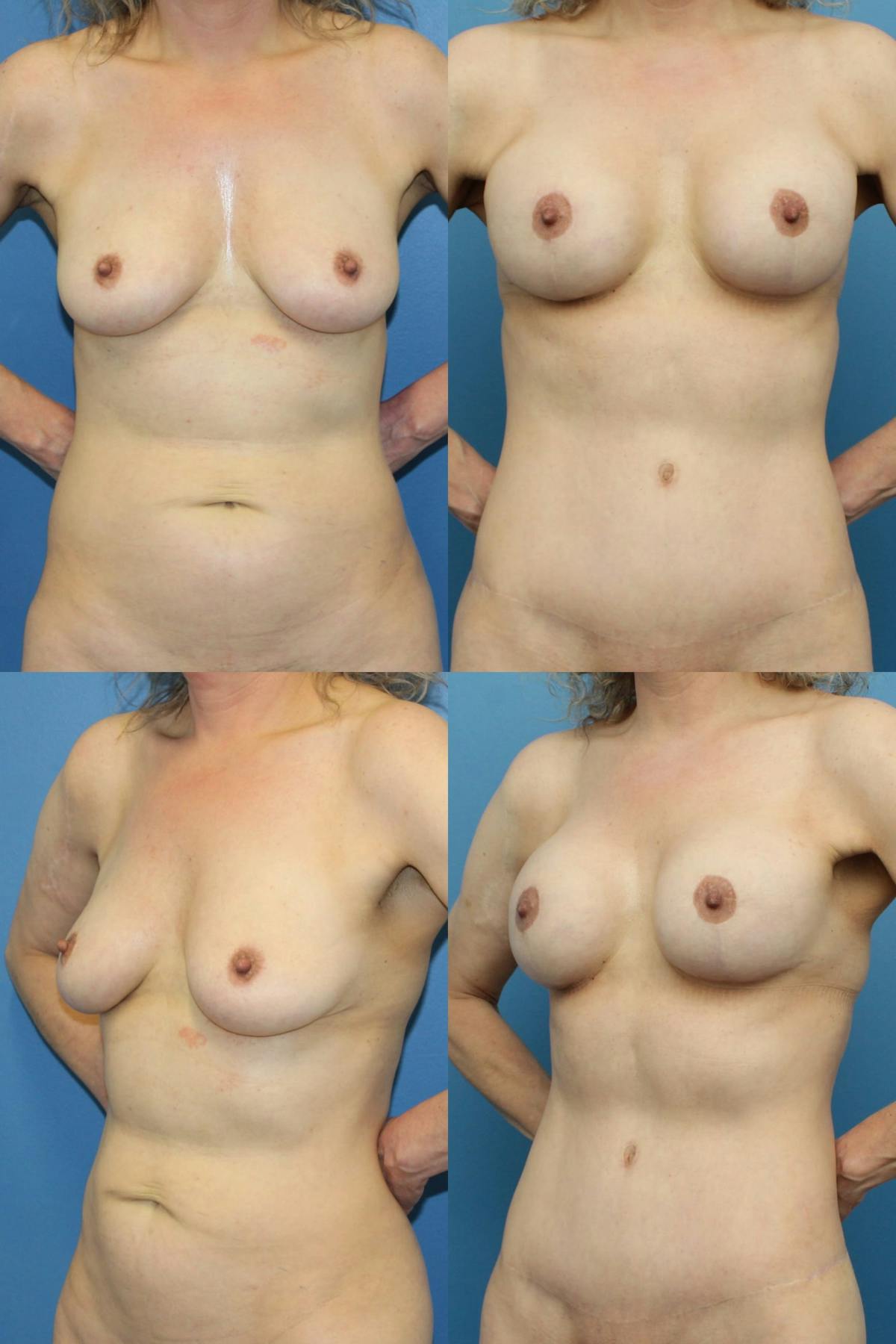 Mommy Makeover Before & After Gallery - Patient 112986 - Image 1