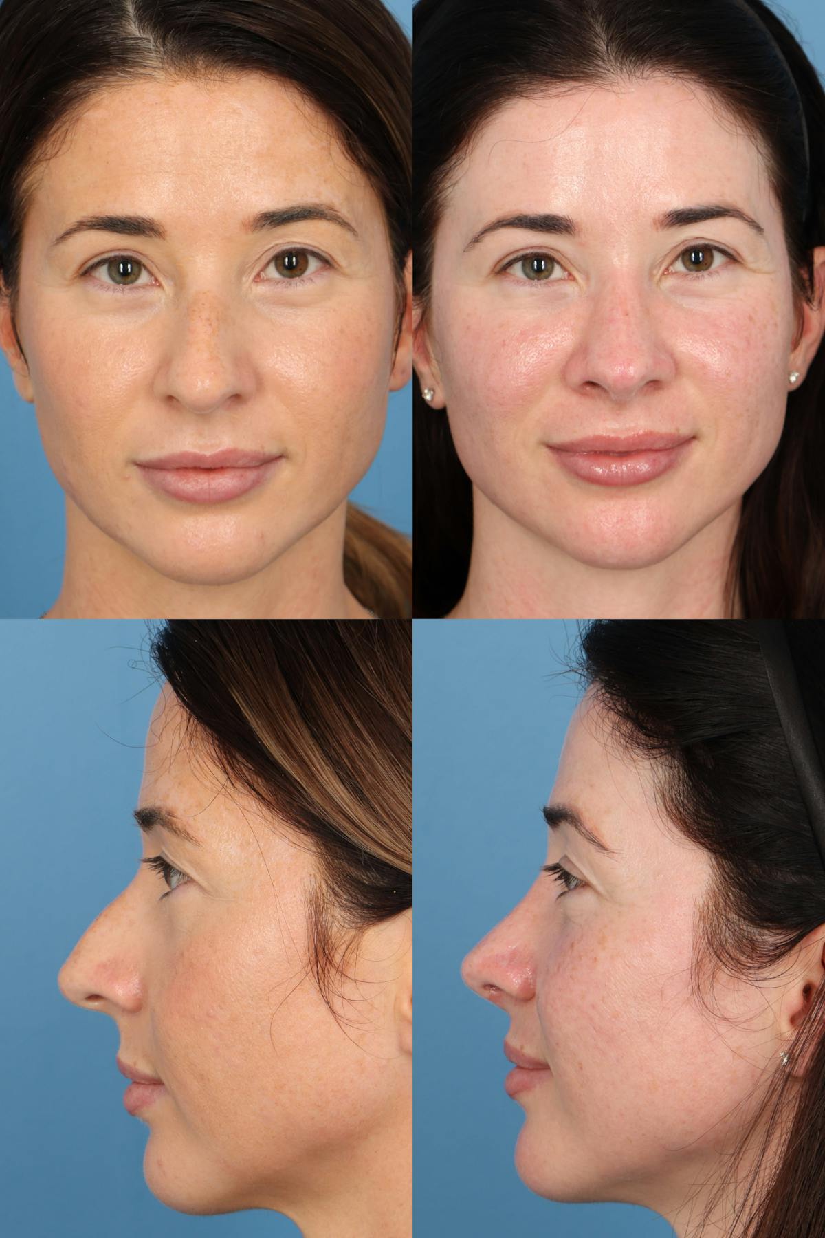 Female Revision Rhinoplasty Before & After Gallery - Patient 417641 - Image 1