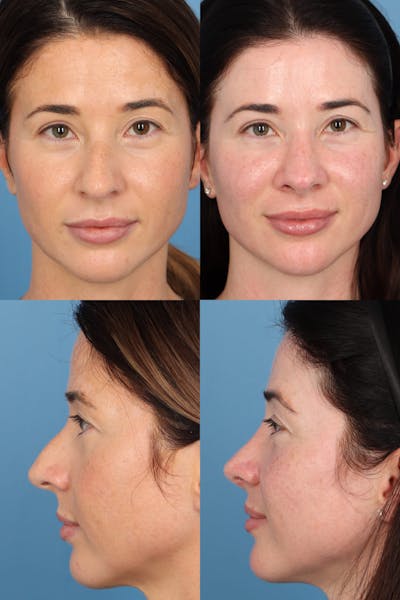 Dorsal Hump Before & After Gallery - Patient HosrjXibQvanFkcteHT3Ug - Image 1