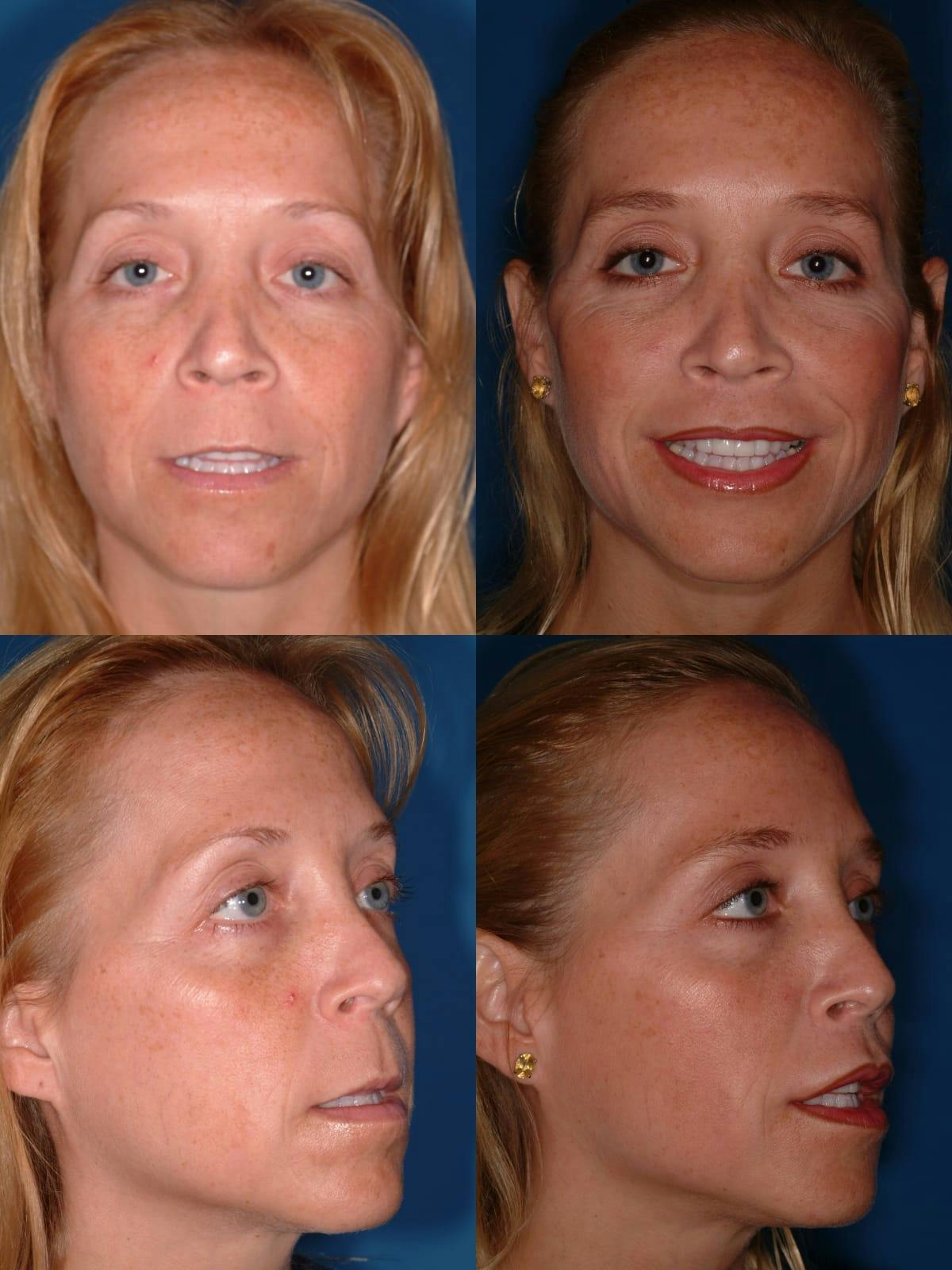Lip Lift Before & After Gallery - Patient 108167 - Image 1