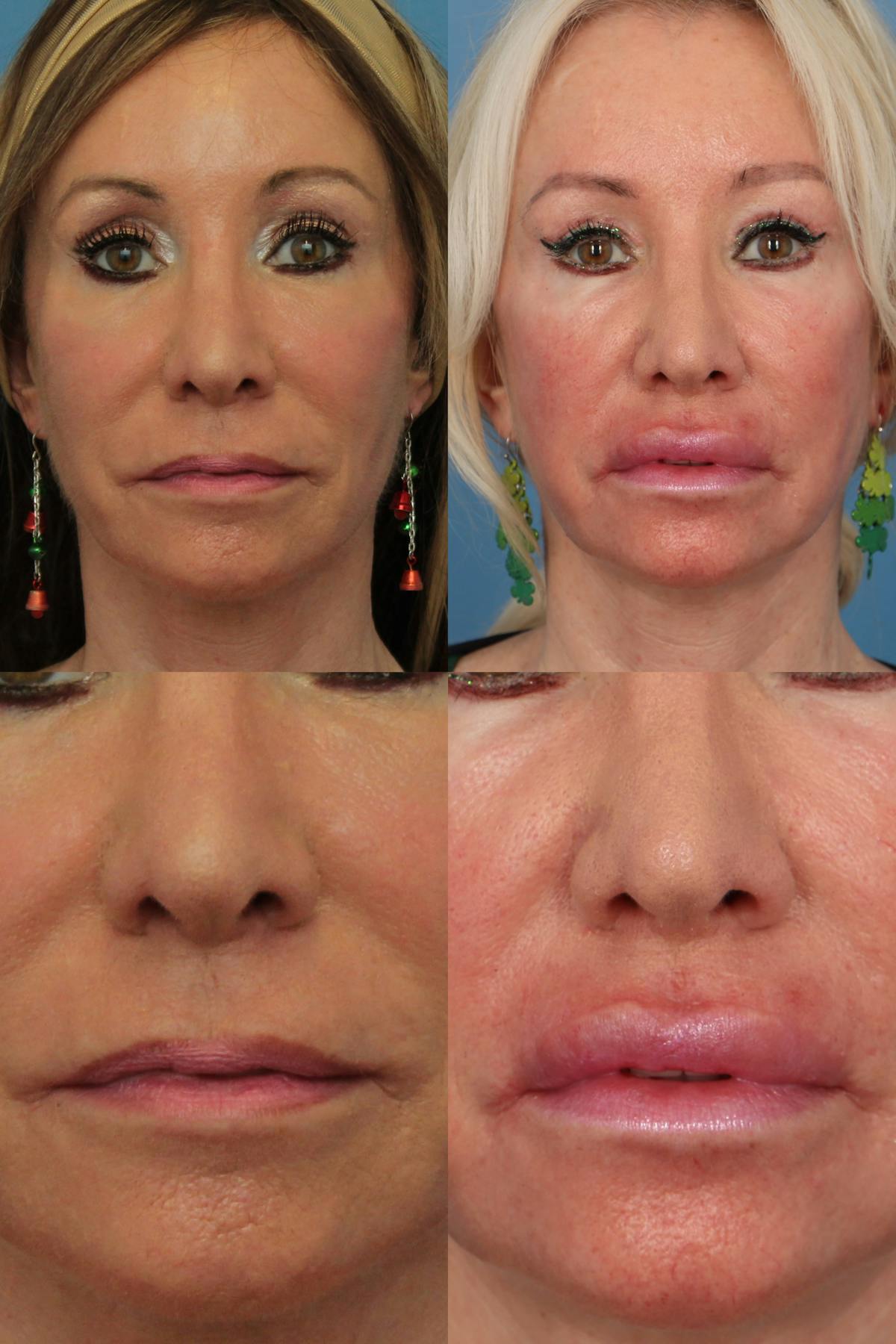 Lip Lift Before & After Gallery - Patient 188743 - Image 1