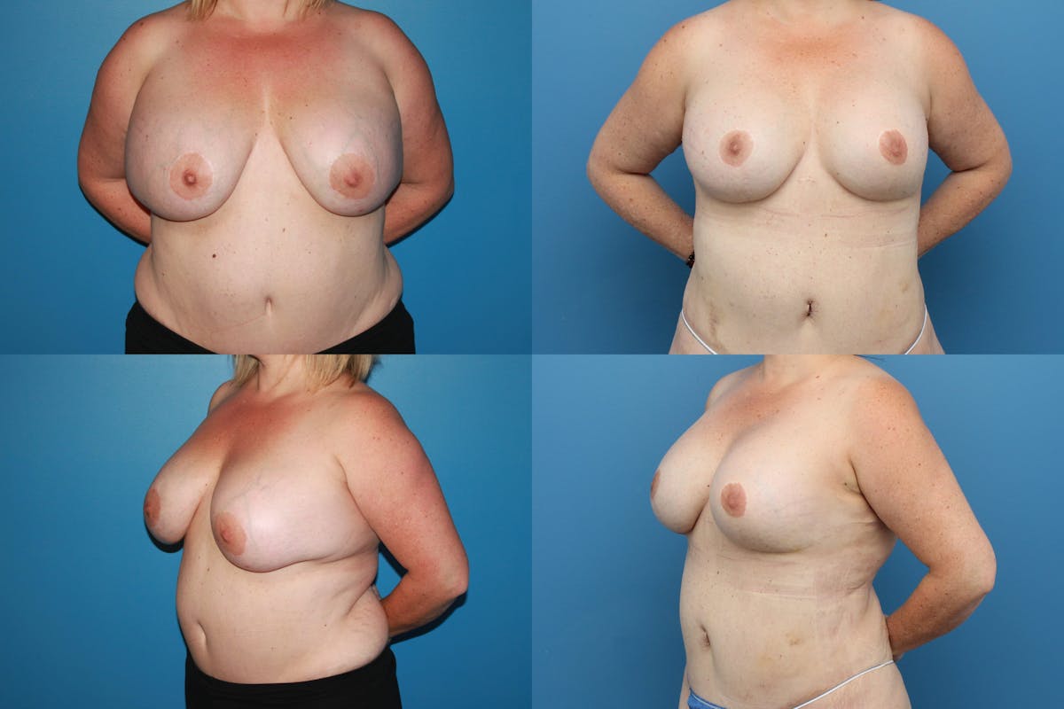 Reductive Augmentation of the Breast Before & After Gallery - Patient 398369 - Image 1