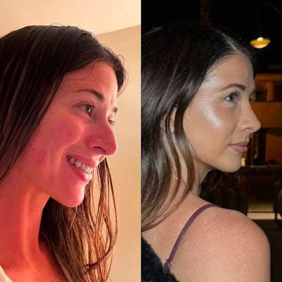 Real Life Patients Before & After Gallery - Patient WCPIhmXJTiKDEowK3T-6ug - Image 1