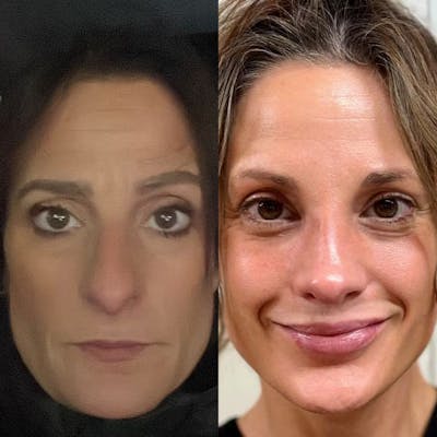 Real Life Patients Before & After Gallery - Patient MJwhkg94RJySuF0C8R0wBQ - Image 1