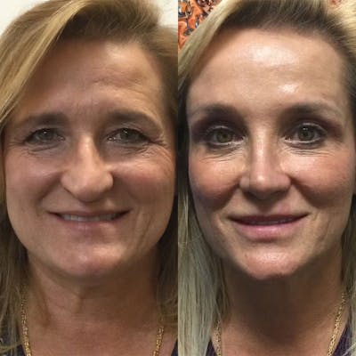 Real Life Patients Before & After Gallery - Patient AXpiiEMDRsWssAcMGHLUzA - Image 1