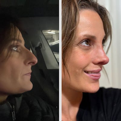 Real Life Patients Before & After Gallery - Patient HOw-iVqKR1KsVUUToax3XA - Image 1