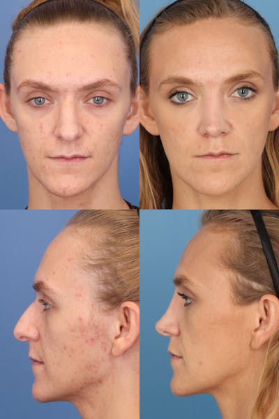 Dorsal Hump Before & After Gallery - Patient YuYUp6G2QZSBHPcslO75xw - Image 1