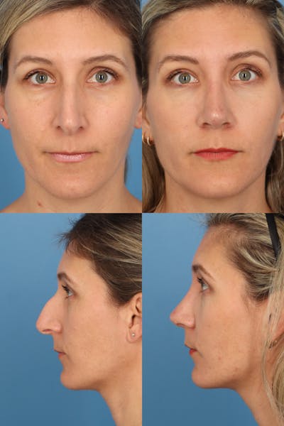 Prominent Nostril / Hanging Columella Before & After Gallery - Patient 223734 - Image 1