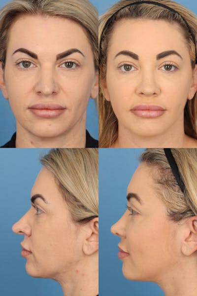 Brow Lift Before & After Gallery - Patient 200810 - Image 1