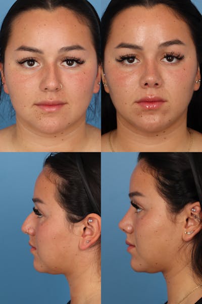 Dorsal Hump Before & After Gallery - Patient OoVcDdl3T6i4ff_disLfHA - Image 1