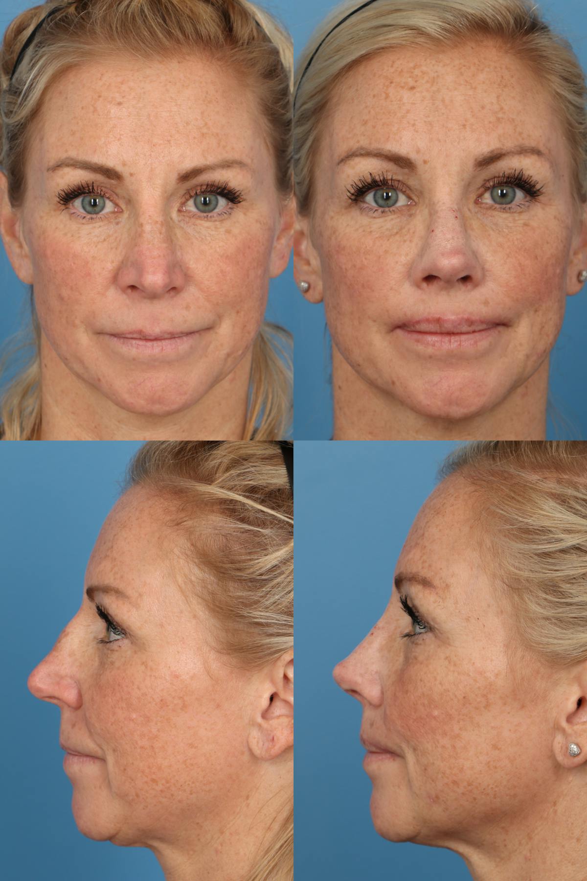 Female Revision Rhinoplasty Before & After Gallery - Patient 477627 - Image 1