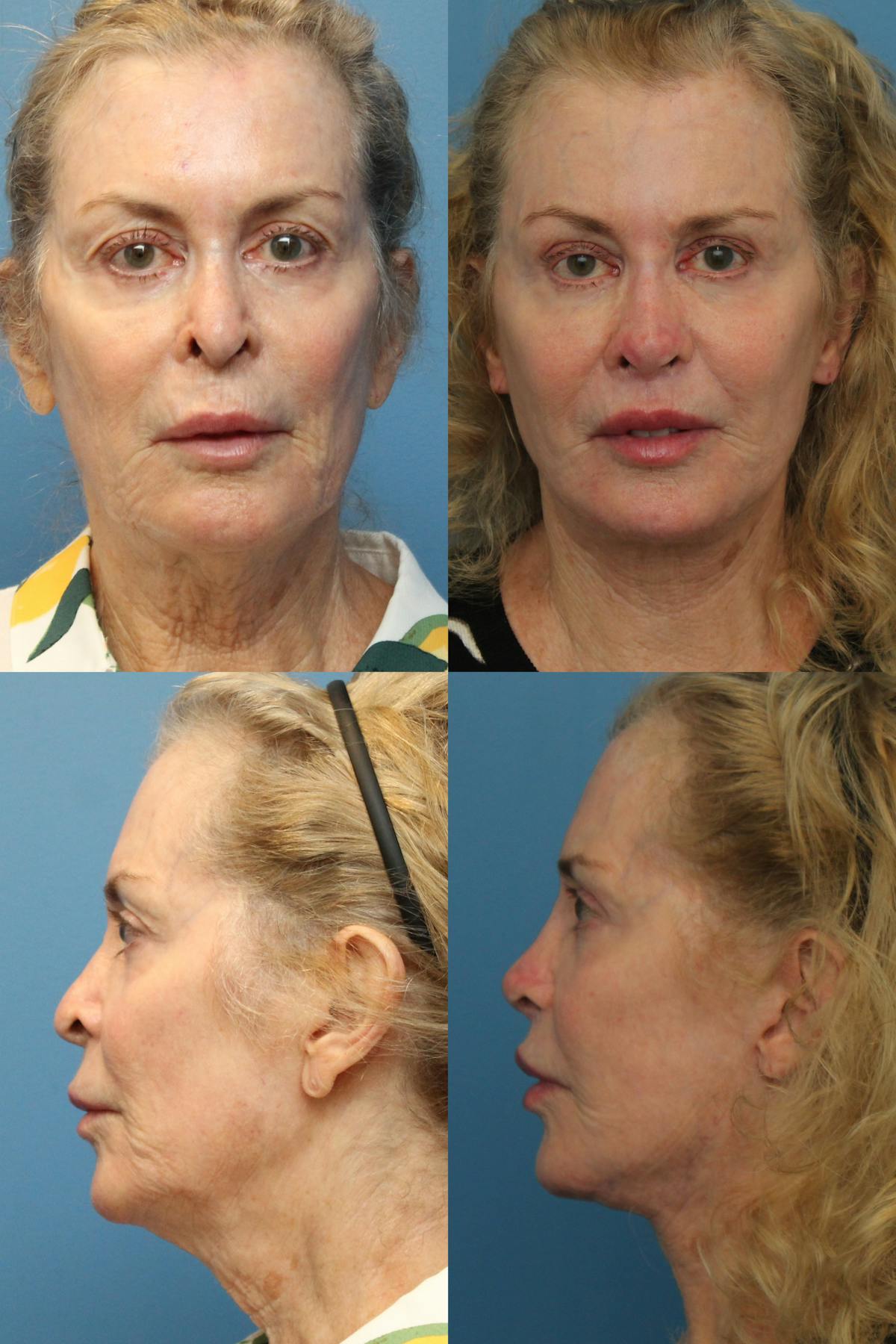 Female Revision Rhinoplasty Before & After Gallery - Patient 184221 - Image 1