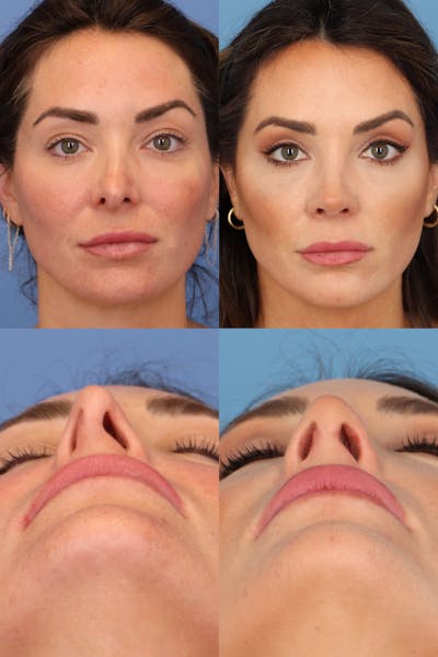 Crooked Nose Before & After Gallery - Patient BD7KKtKESBWc08tYg1nrew - Image 1
