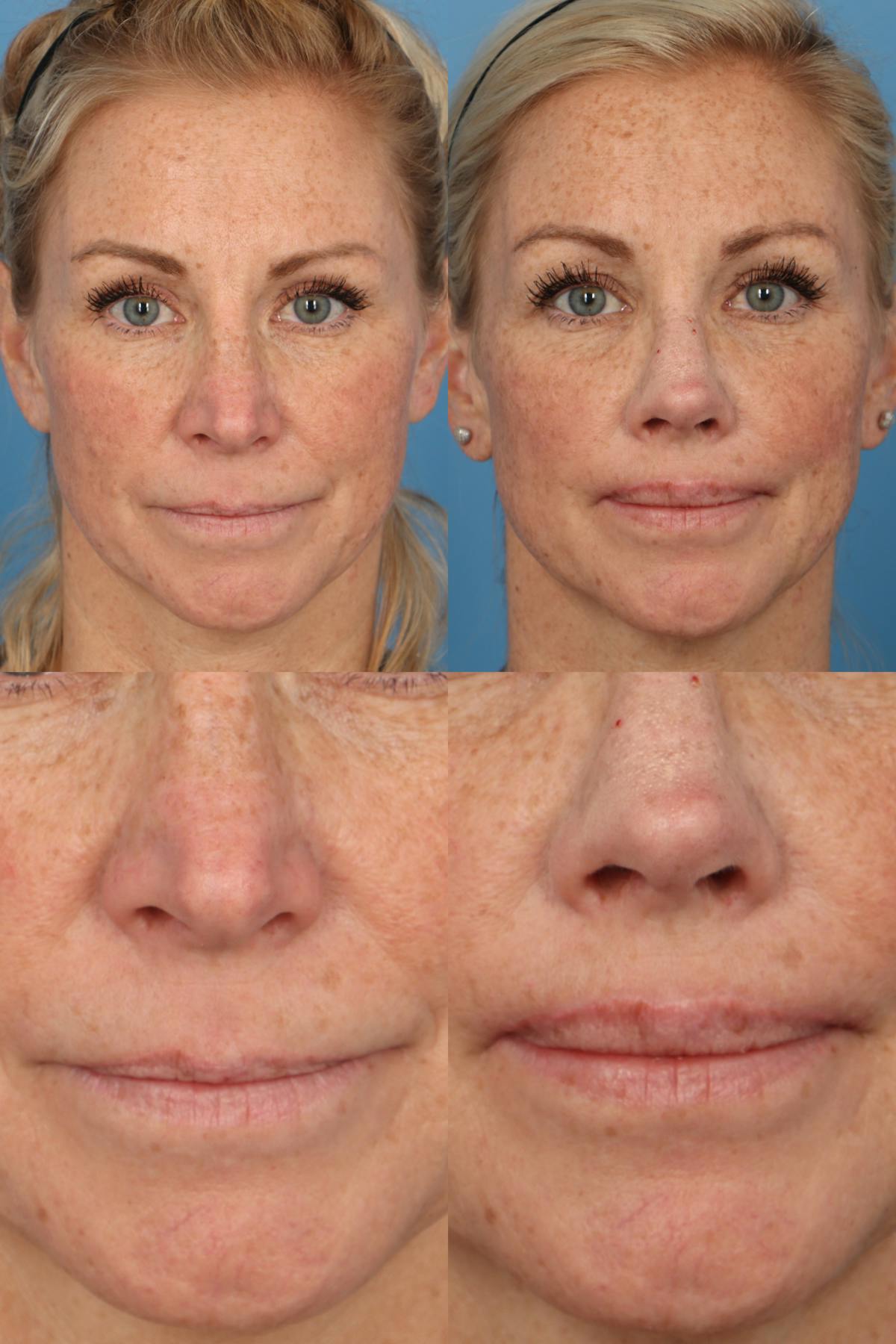 Lip Lift Before & After Gallery - Patient 274304 - Image 1