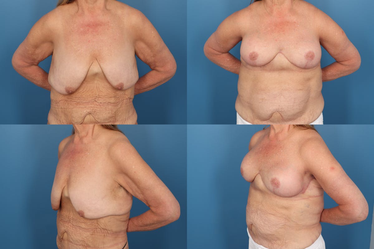 Reductive Augmentation of the Breast Before & After Gallery - Patient 108272 - Image 1