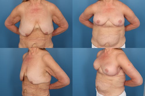 Patient 5 Before - Reverse Tummy Tuck