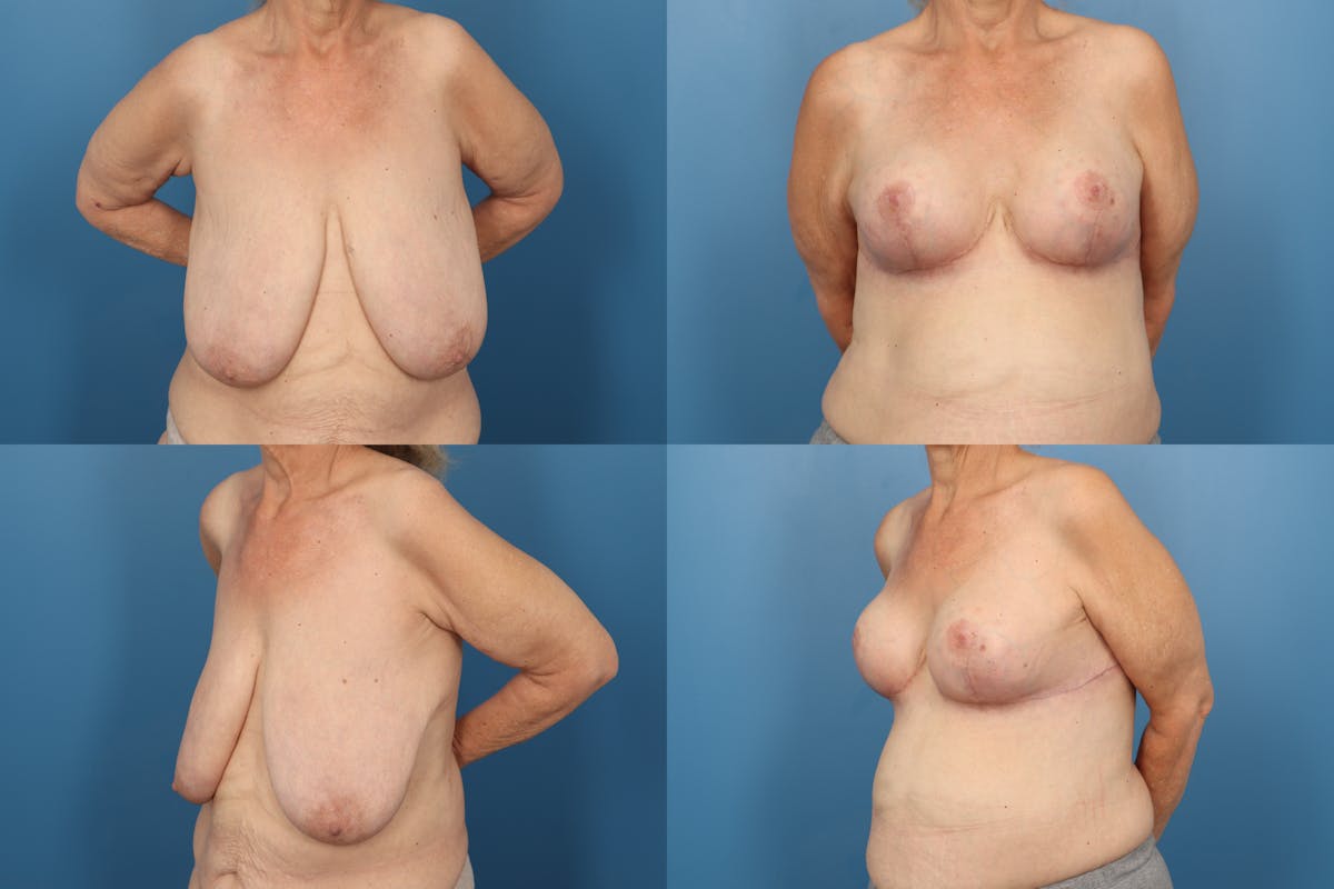 Reductive Augmentation of the Breast Before & After Gallery - Patient 151202 - Image 1
