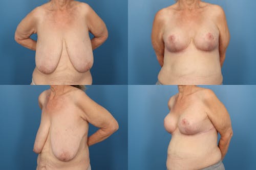 Patient 3 Before - Reverse Tummy Tuck