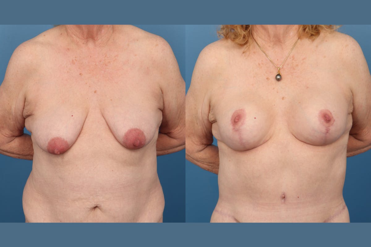 Circumareolar / Donut Lift Before & After Gallery - Patient 868658 - Image 1