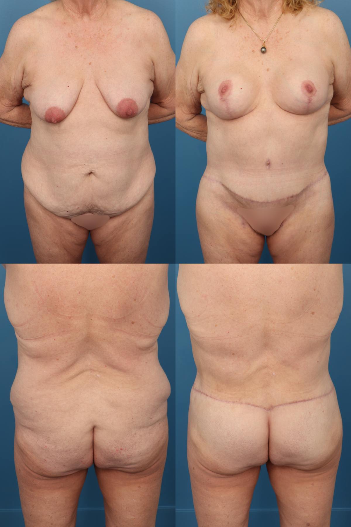 Body Lift / Thigh Lift Before & After Gallery - Patient 377924 - Image 1