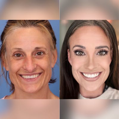 Real Life Patients Before & After Gallery - Patient dPiIx6XtQW2WZUUJjox2sg - Image 1