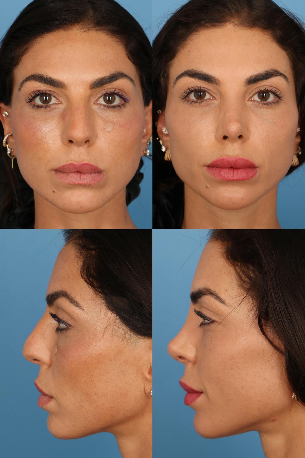 Dorsal Hump Before & After Gallery - Patient 116045 - Image 1