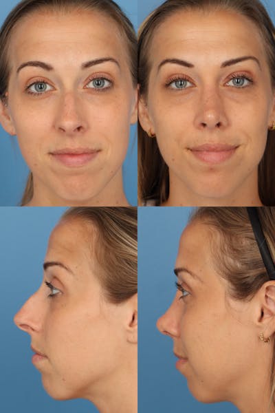 Over Projecting Tip Before & After Gallery - Patient b4u5kh3_TKmtw8X6mz1Cbw - Image 1