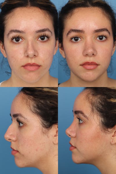 Dorsal Hump Before & After Gallery - Patient UwdTkBhmRkSrlM8_Y3KYkQ - Image 1