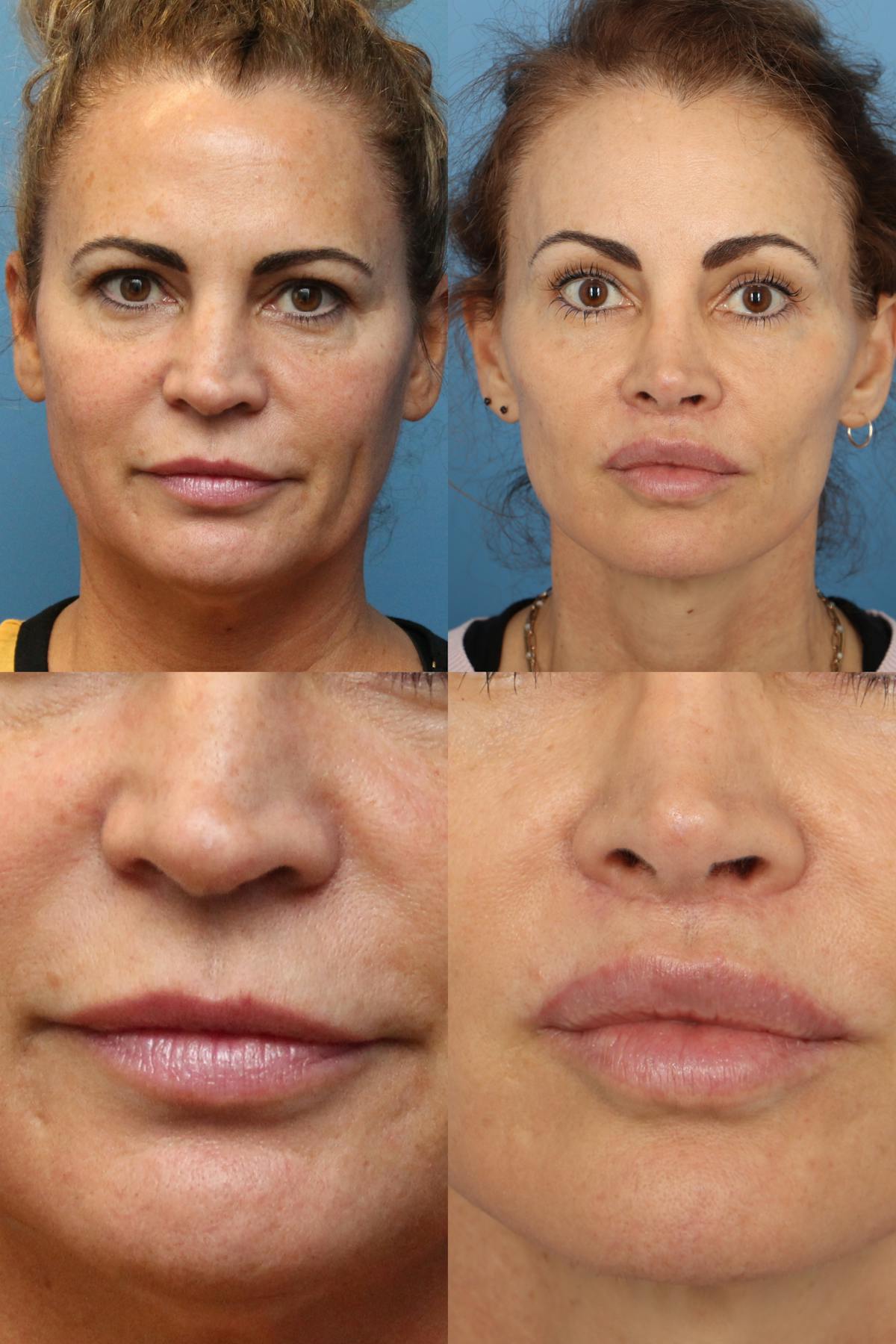 Lip Lift Before & After Gallery - Patient 902910 - Image 1