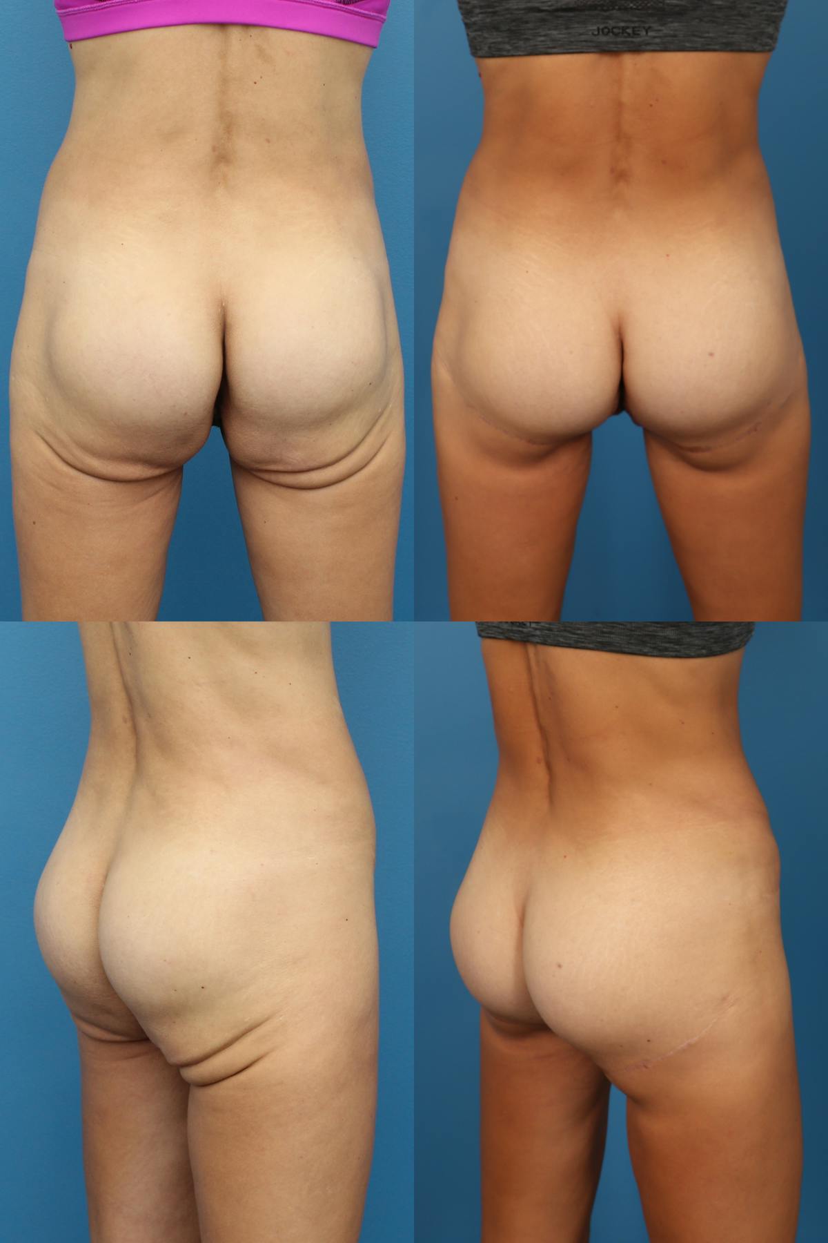 Thong Lift / Infragluteal Thigh Lift Before & After Gallery - Patient 181812 - Image 1